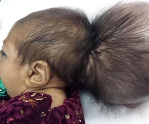 Afghan baby with TWO HEADS 