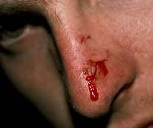 two man fought, one bite off nose of other