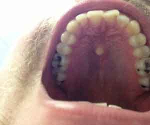 Man has tooth growing in middle of his mouth 