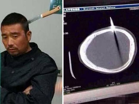 Man calmly walks into hospital with 10 INCH knife buried in his skull