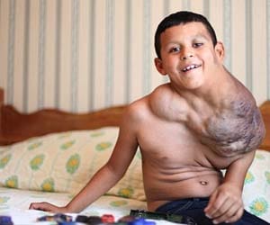 Boy with giant tumour 