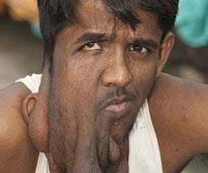 man with huge facial tumour 