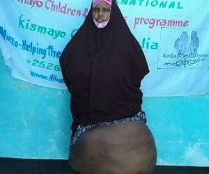 woman suffering from elephantiasis