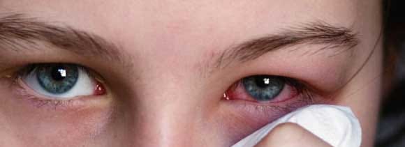 conjunctivitis eye disease winters