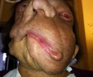 Woman disfigured by huge facial tumour 
