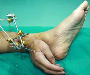 hand attached with ANKLE 