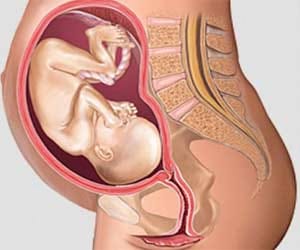 Woman with two uteruses gives birth to twin daughters One in 50 crore women in the world has uterine didelphys