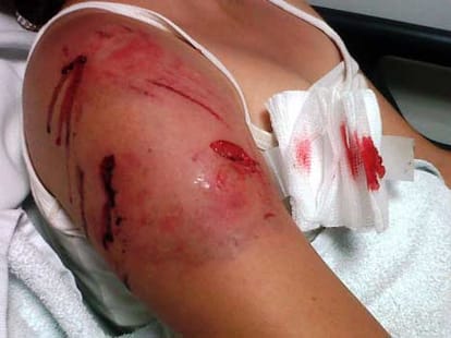 dog attacked