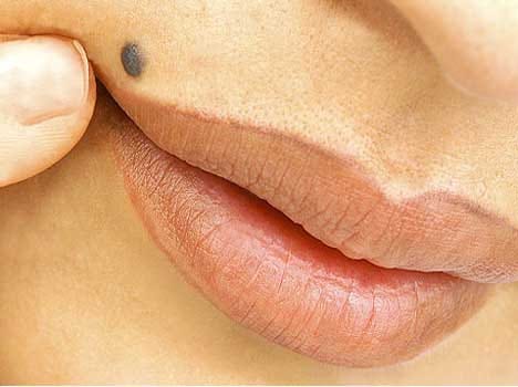 home remedies to get rid of mole