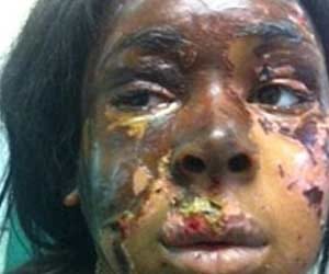 acid attack