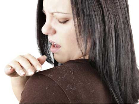 home remedies to prevent dandruff