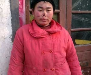 Woman whose nose and lip were bitten off by mice
