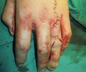 surgeon turns student’s toe into a finger
