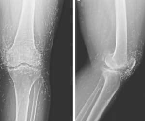 X-ray reveals hundreds of gold needles