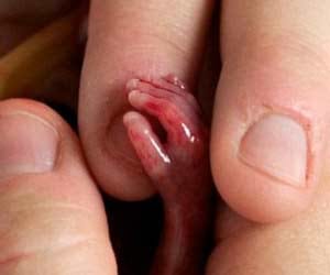 abortion cases are rising in delhi