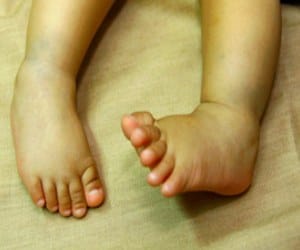 9 lakhs for artificial foot by insurance company 