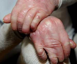 rare medical condition