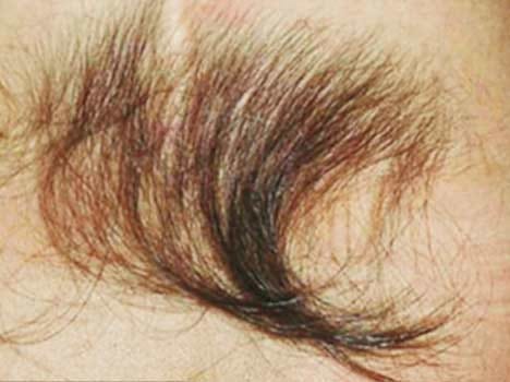 hair transplant center in haldwani