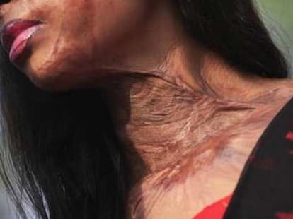 Brave acid attack victims in lucknow 