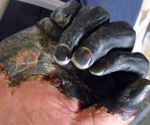 hands and feet turned black 
