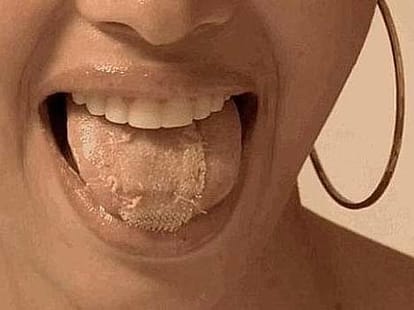 I have plastic sewn to my tongue