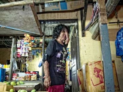 woman suffering from rare medical case