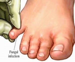 Rainy disease, men dominate in winter