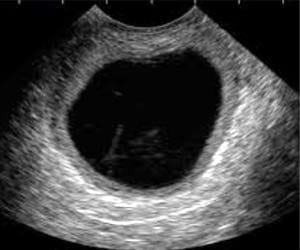 35 kg cyst in body