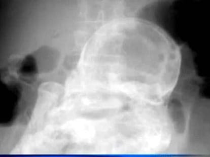 Doctors discover 44-year-old FOETUS 
