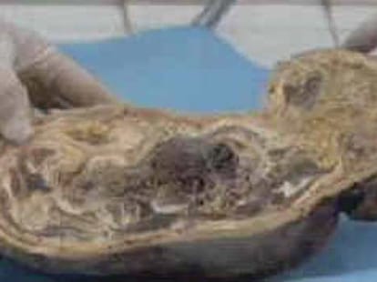 Doctors discover 44-year-old FOETUS 