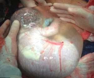 Karna heat death of babies in the womb are