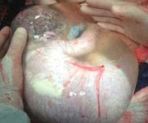 baby born with sac