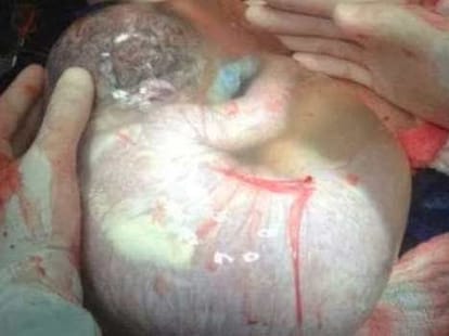 baby born with sac