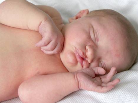 program on cleft lip problems in children