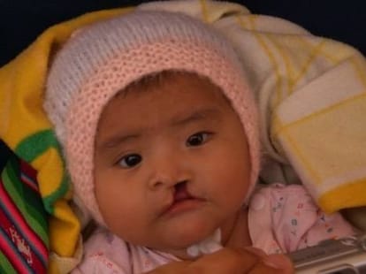program on cleft lip problems in children