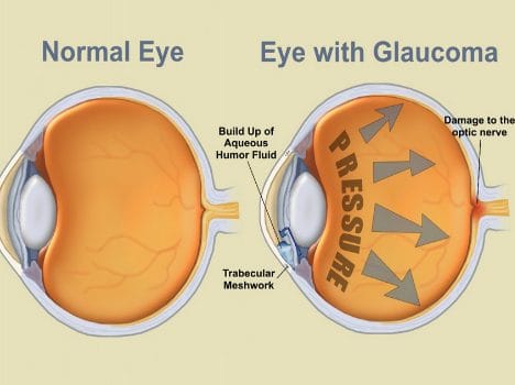 world glaucoma day 2024 glaucoma in children causes and prevention in hindi