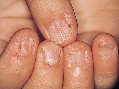 palmistry nails health