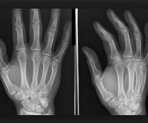 girl suffering from osteogenesis