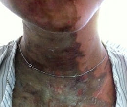 Kaithal -Acid attack on Family