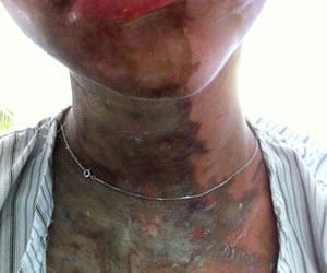 Threw acid on woman in Delhi