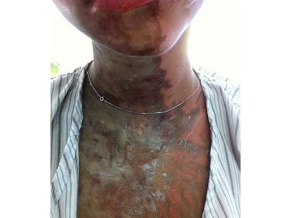 acid attack on woman