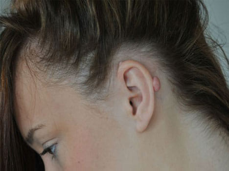 lump of scar left after ear scaffold removing surgery