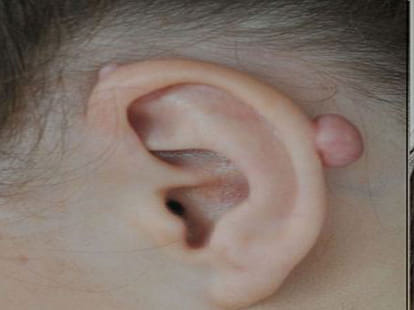 lump of scar left after ear scaffold removing surgery