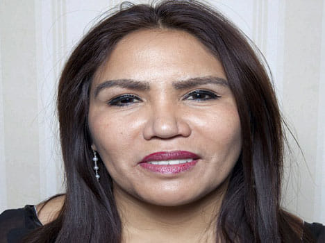 women got new eyelashes and eye brows  transplanted from hair 