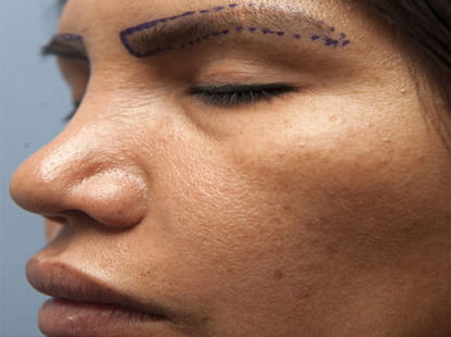 women got new eyelashes and eye brows  transplanted from hair 
