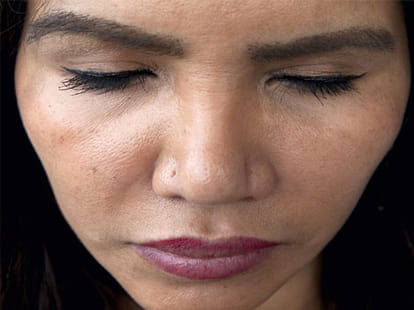 women got new eyelashes and eye brows  transplanted from hair 