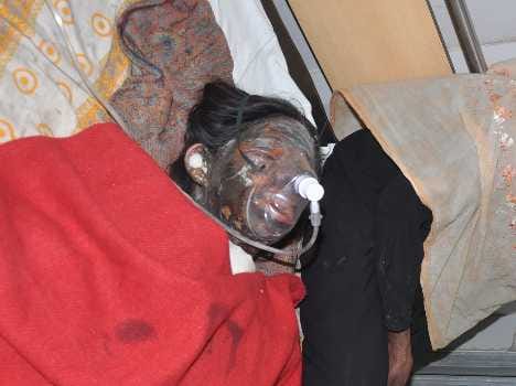 acid attack on woman