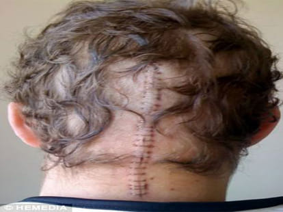 doctors misdiagonosed man, making him look like egyptian mummy