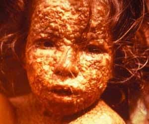 climate_change_small_pox
