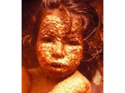 climate_change_small_pox